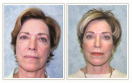 Actual Facial Plastic Surgery Patient