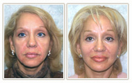 Actual Facial Plastic Surgery Patient