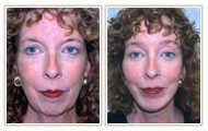 Actual Facial Plastic Surgery Patient