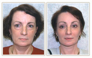 Actual Facial Plastic Surgery Patient