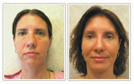 Actual Facial Plastic Surgery Patient