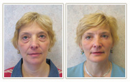 Actual Facial Plastic Surgery Patient