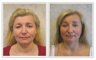 Actual Facial Plastic Surgery Patient
