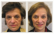 Actual Facial Plastic Surgery Patient