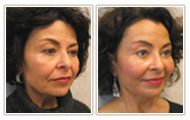 Actual Facial Plastic Surgery Patient